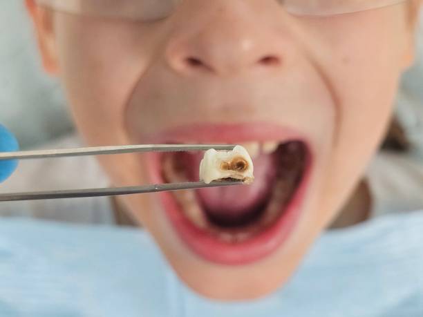 Best Emergency Dental Care for Broken or Chipped Teeth in USA